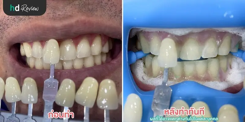 รีวิว ฟอกสีฟัน น้ำยา PolaOffice ที่ Zenitoni Dental Clinic