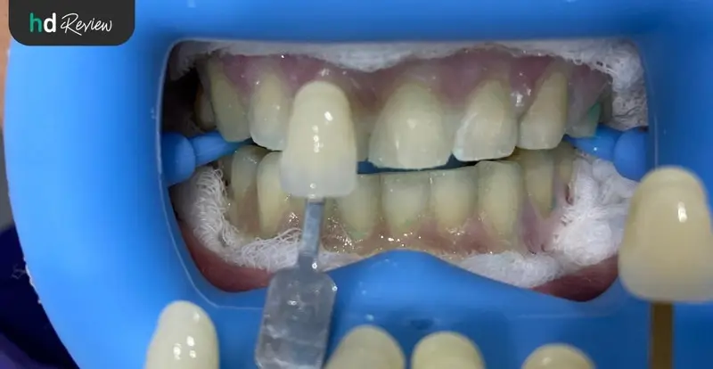 รีวิว ฟอกสีฟัน น้ำยา PolaOffice ที่ Zenitoni Dental Clinic